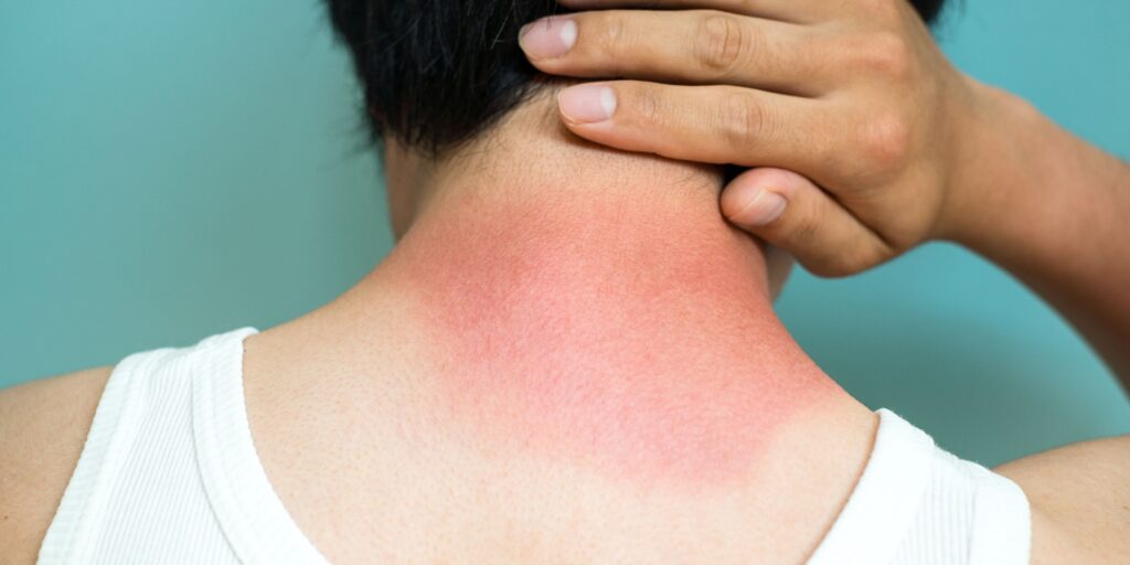 photo of a sunburned neck to illustrate a post about home remedies for sunburn.