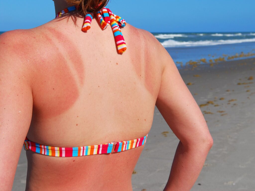 photo of a woman's sunburned back at the beach to illustrate a post about natural remedies for sunburn. 